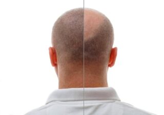 کاشت مو نوشهر