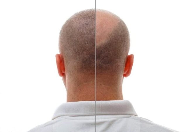 کاشت مو نوشهر