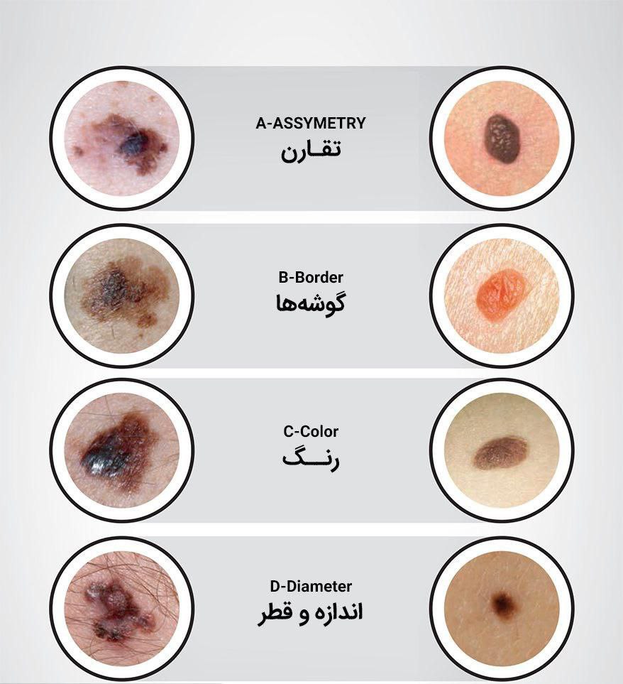 انواع خال پوستی