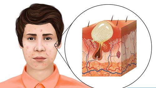 درمان آکنه و جوش در نوشهر