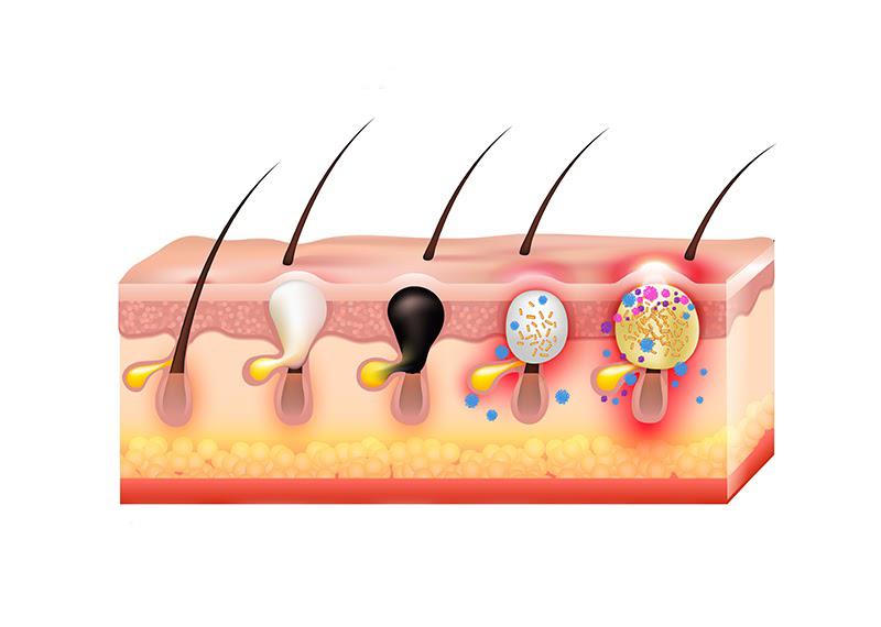 درمان آکنه و جوش در نوشهر