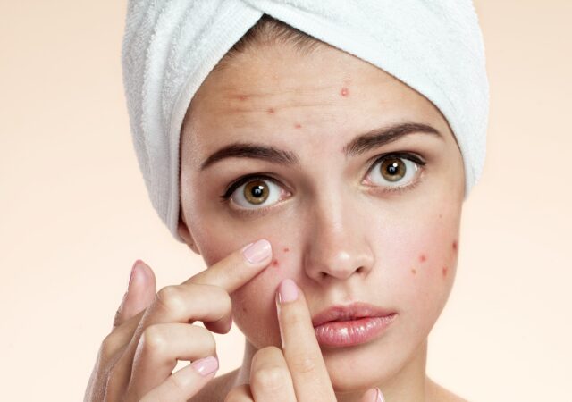 درمان آکنه و جوش در نوشهر