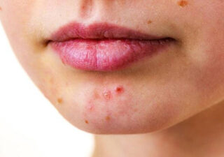 علائم و نشانه های بیماری های رایج پوستی