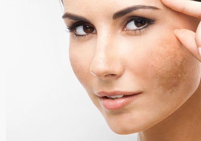 درمان تخصصی انواع لک پوست در نوشهر و مازندران