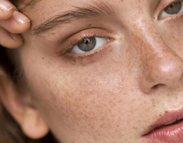 درمان و پیشگیری کک و مک صورت در نوشهر، چالوس و کلاردشت