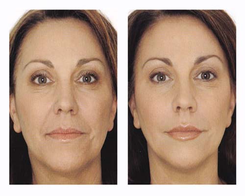 مزوتراپی برای لکهای صورت