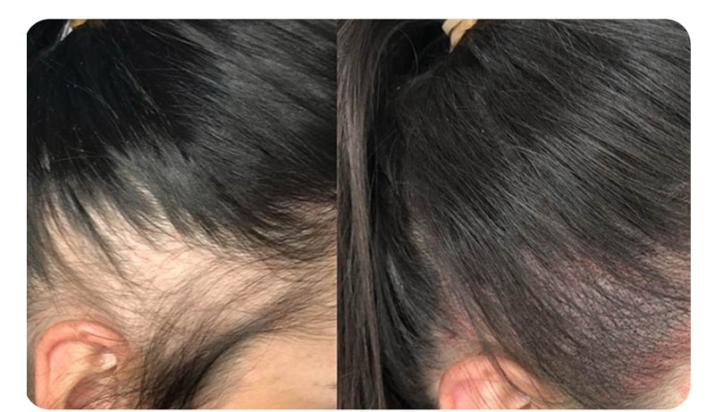 اسکالپ سر برای درمان چربی و شوره (1)