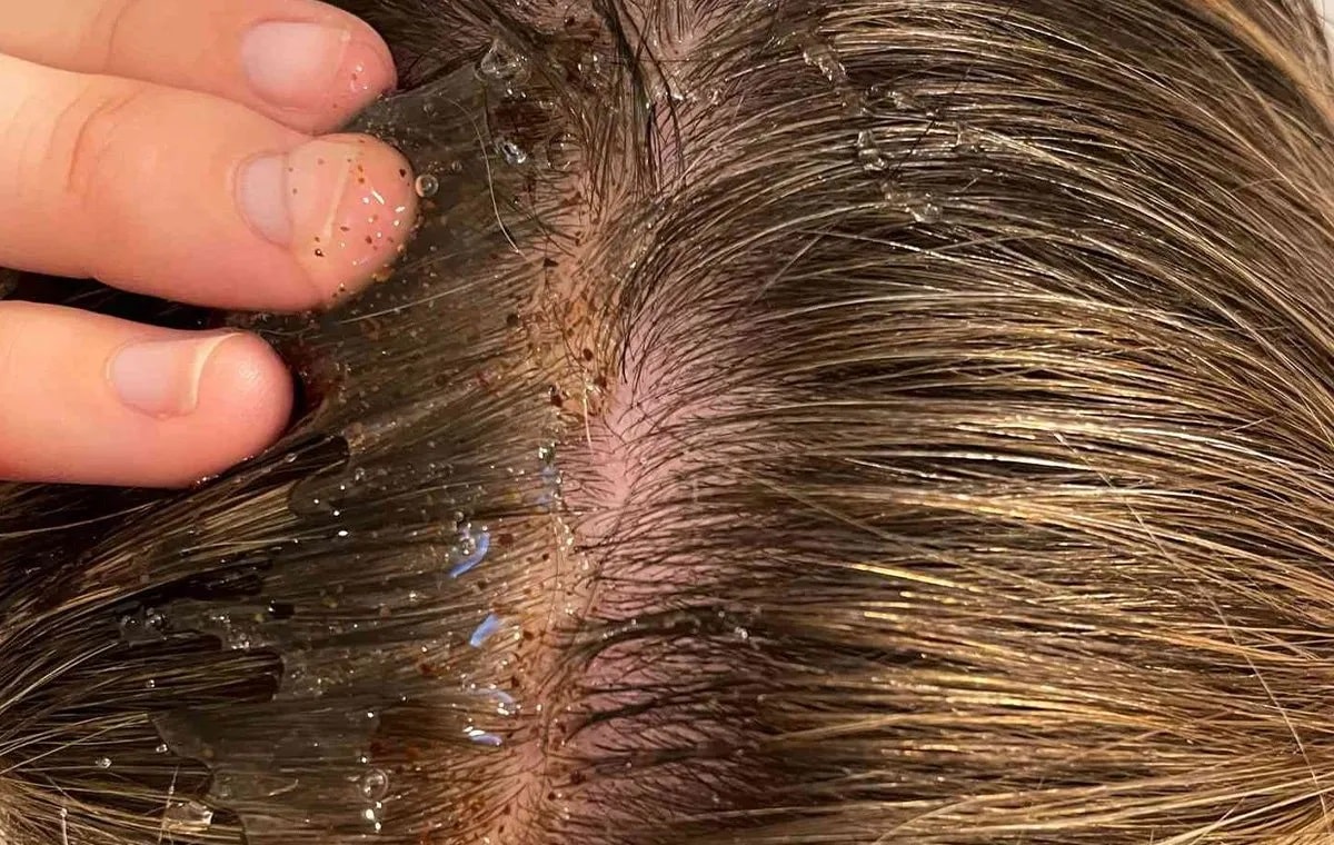 اسکالپ سر برای درمان چربی و شوره