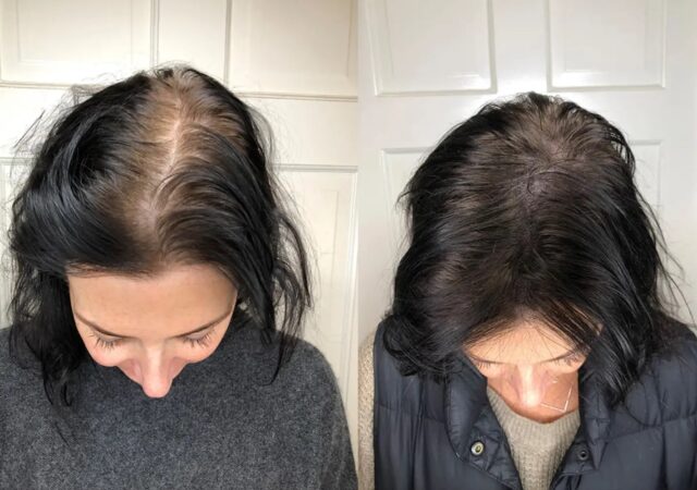 اسکالپ سر برای درمان چربی و شوره