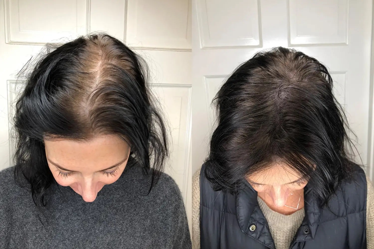 اسکالپ سر برای درمان چربی و شوره