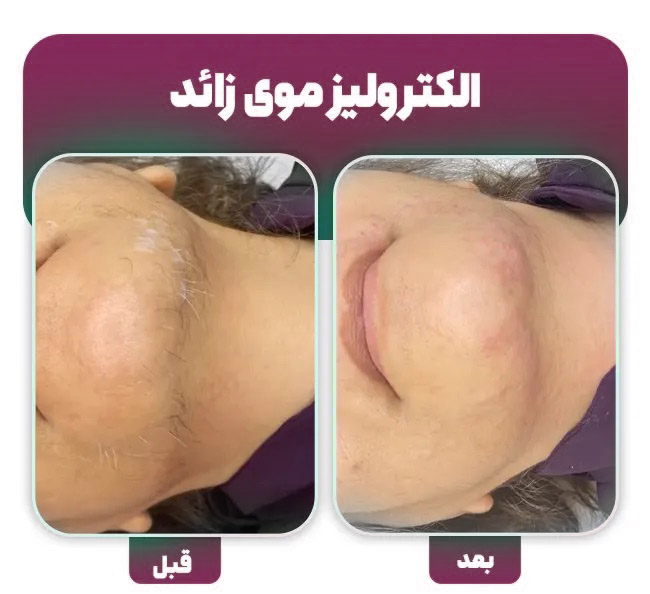 الکترولیز در نوشهر